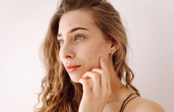 Acne Treatment Cape Town